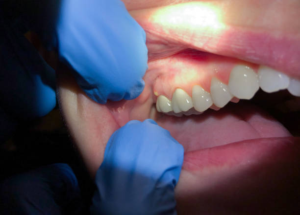 Best Emergency Broken Tooth Repair in Jensen Beach, FL